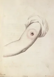 Kuhpockenpustel auf einem Arm, aus 